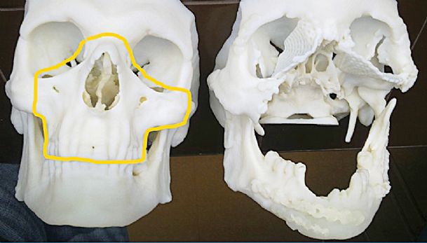 Man gets record-setting face transplant